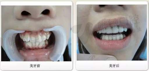 活动假牙贵和便宜的区别,补牙材质贵和便宜的区别(图1)